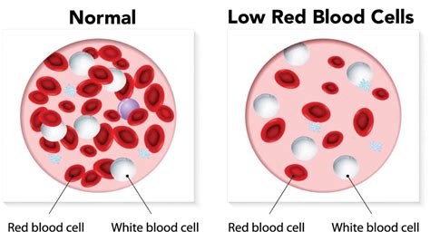 low red blood cell count